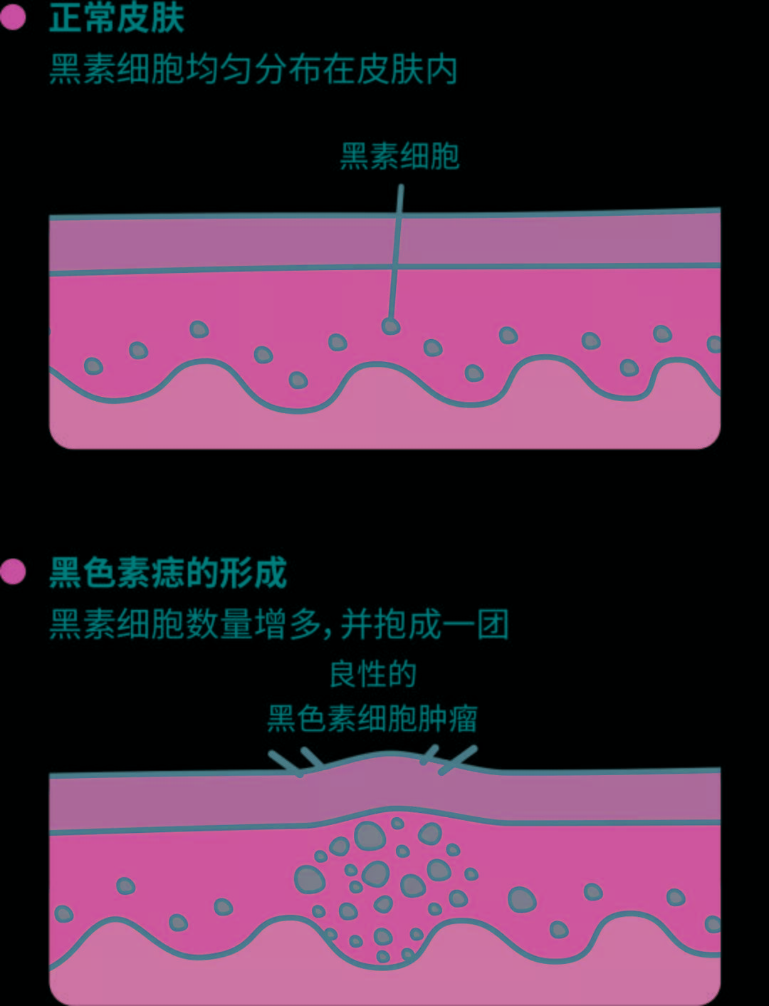 脚底长痣长痣别大意，有可能是黑色素瘤？(组图)