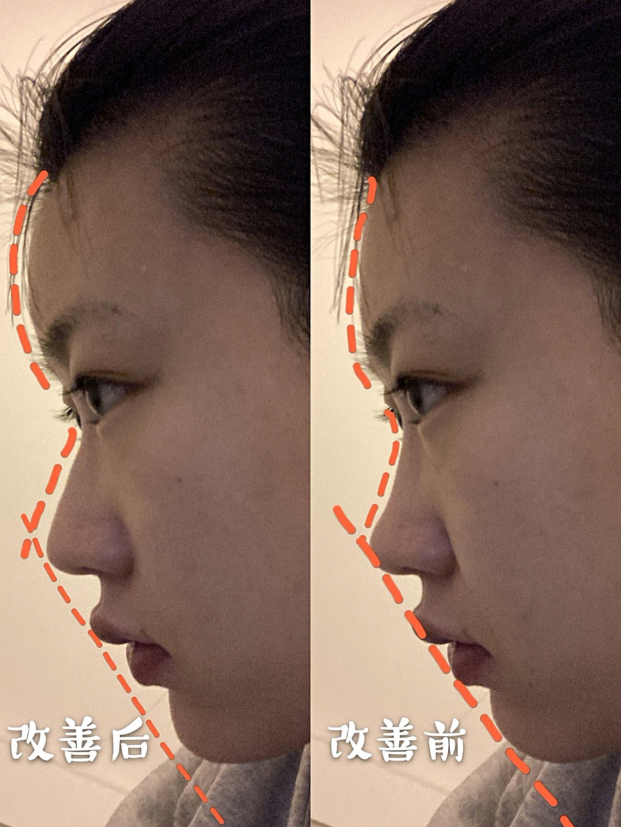 鼻基底凹陷和面中部凹陷的区别在哪里？ - 知乎